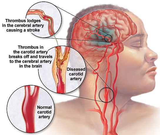 The Signs Of The Emergence Of a Stroke